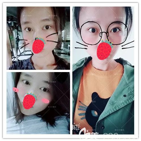 想知道怎么從無神眼變?yōu)殡娙颂一ㄑ?蘇州美貝爾醫(yī)生分享眼綜合案例蛻變看過就知道