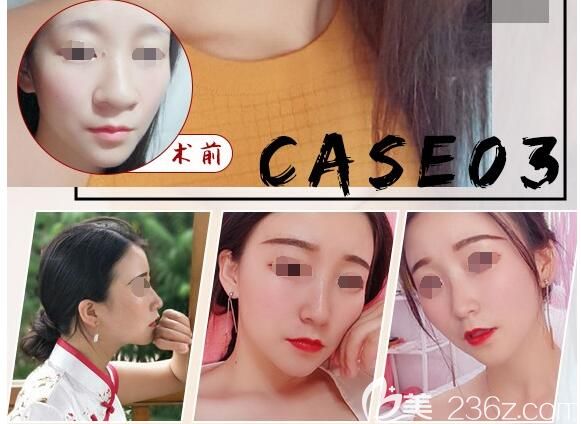 文國忠院長(zhǎng)隆鼻案例對(duì)比 文國忠院長(zhǎng)隆鼻案例對(duì)比