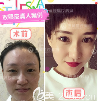 許川醫(yī)生雙眼皮案例