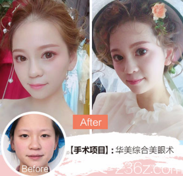 裴彥鵬醫(yī)生雙眼皮案例