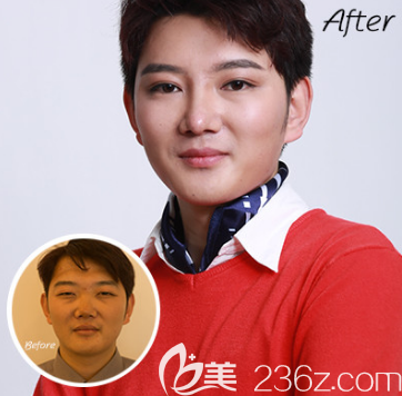 魏璐醫(yī)生雙眼皮案例