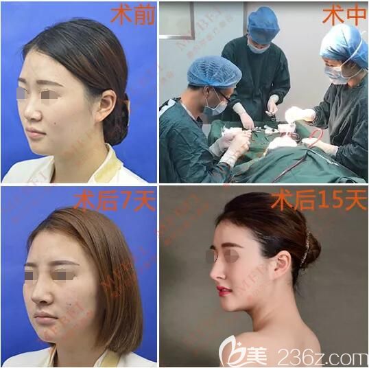 23歲的黃小姐到蘇州美貝爾做MEBEL?天然鼻蛻變