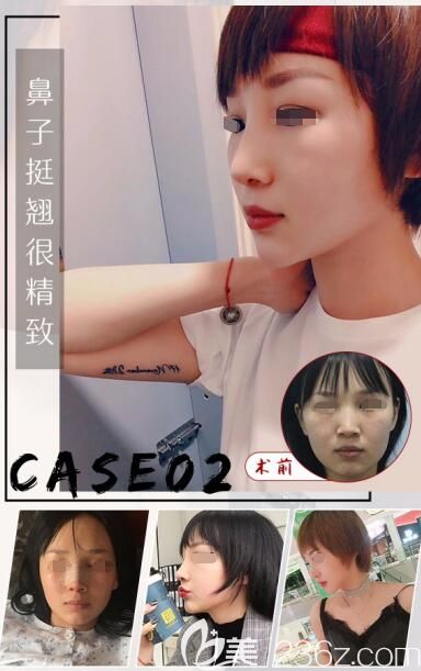 三組案例告訴你為什么都選擇蘇州美貝爾文國忠醫(yī)生做隆鼻，除了醫(yī)生專業(yè)還有鼻技術(shù)