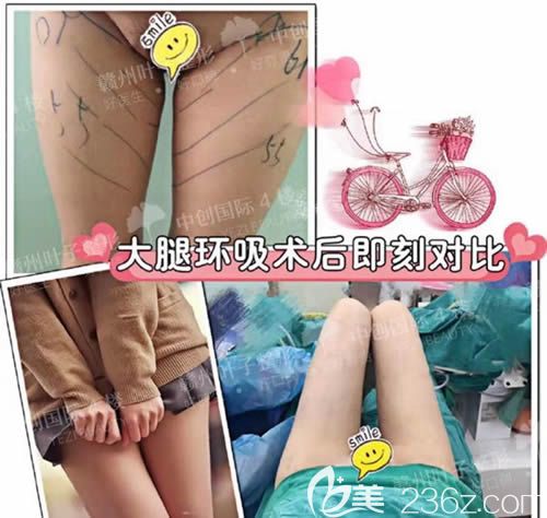 贛州葉子整形醫(yī)院大腿吸脂前后對比照 贛州葉子整形醫(yī)院大腿吸脂前后對比照