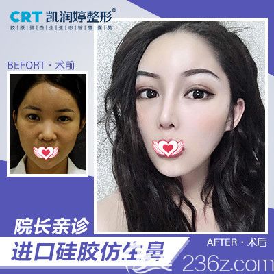 廊坊凱潤(rùn)婷3.15安心醫(yī)美節(jié)大量整形優(yōu)惠活動(dòng)來(lái)襲 大腿吸脂低至780元