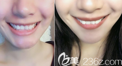 北京美萊王凱醫(yī)生隱形牙齒矯正案例 北京美萊王凱醫(yī)生隱形牙齒矯正案例
