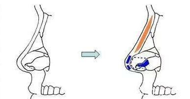 <!--<i data=20240703-sp></i>-->美萊醫(yī)療美容醫(yī)院<!--<i data=20240703-sp></i>-->隆鼻知識