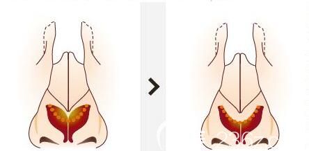 <!--<i data=20240703-sp></i>-->美萊醫(yī)療美容醫(yī)院<!--<i data=20240703-sp></i>-->光墊高鼻子是不行的