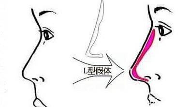 <!--<i data=20240703-sp></i>-->美萊醫(yī)療美容醫(yī)院<!--<i data=20240703-sp></i>-->隆鼻假體如何選擇