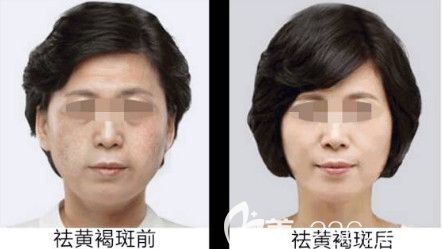 攸海濤醫(yī)生祛除黃褐斑案例 攸海濤醫(yī)生祛除黃褐斑案例