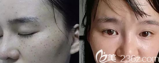 景德鎮(zhèn)圣嘉麗激光祛斑真人案例效果前后對(duì)比圖 景德鎮(zhèn)圣嘉麗激光祛斑真人案例效果前后對(duì)比圖