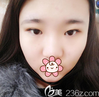 去<i data-id='7cc5e2dd-54d7-4e0e-bdbc-263b227ff84a' style='display:none;'></i>做眼睛前的素顏照片 去<i data-id='7cc5e2dd-54d7-4e0e-bdbc-263b227ff84a' style='display:none;'></i>做眼睛前的素顏照片