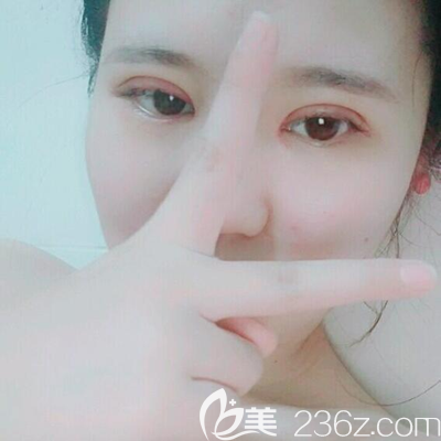 <i data-id='7cc5e2dd-54d7-4e0e-bdbc-263b227ff84a' style='display:none;'></i>眼綜合術(shù)后即刻 <i data-id='7cc5e2dd-54d7-4e0e-bdbc-263b227ff84a' style='display:none;'></i>眼綜合術(shù)后即刻