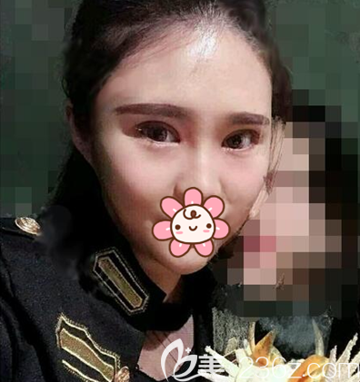 雙眼皮開眼角術(shù)后7天拆線效果 雙眼皮開眼角術(shù)后7天拆線效果