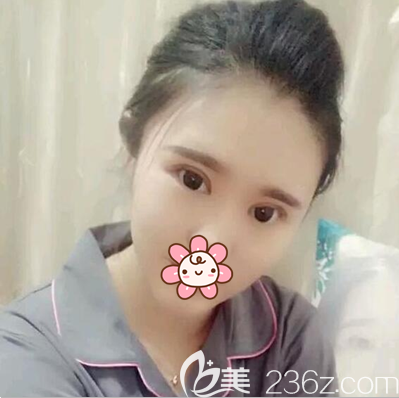 張作香雙眼皮開眼角加提肌術(shù)后半個(gè)月 張作香雙眼皮開眼角加提肌術(shù)后半個(gè)月