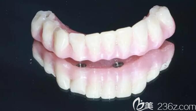 全口種植所用牙冠