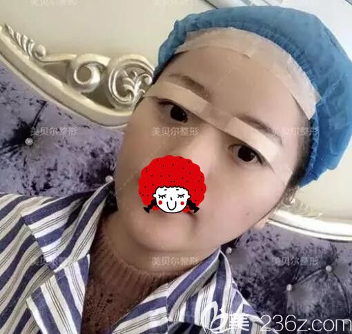 剛做完埋線法雙眼皮+上瞼下垂矯正的眼部整形手術(shù)術(shù)后即刻 剛做完埋線法雙眼皮+上瞼下垂矯正的眼部整形手術(shù)術(shù)后即刻