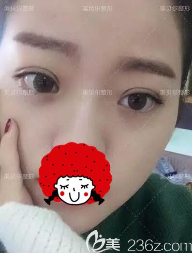 術(shù)后一周埋線法雙眼皮+上瞼下垂矯正的眼部整形手術(shù)恢復(fù)中 術(shù)后一周埋線法雙眼皮+上瞼下垂矯正的眼部整形手術(shù)恢復(fù)中