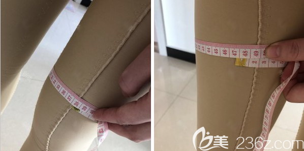 術(shù)后幫個(gè)月測(cè)量腿圍小了7CM 術(shù)后幫個(gè)月測(cè)量腿圍小了7CM