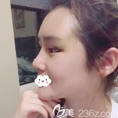 全面部脂肪填充術(shù)后3天 全面部脂肪填充術(shù)后3天