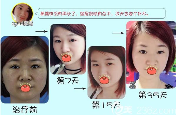 瑞安瑞麗醫(yī)院任震祛黃褐斑案例