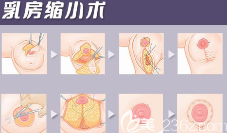 乳房縮小術(shù)示意圖 乳房縮小術(shù)示意圖