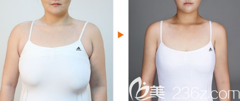 乳房縮小手術(shù)案例 乳房縮小手術(shù)案例