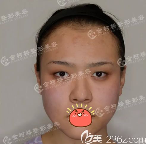 <!--<i data=20240703-sp></i>-->醫(yī)院做雙眼皮前 <!--<i data=20240703-sp></i>-->醫(yī)院做雙眼皮前