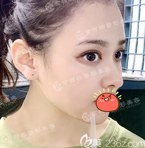 <!--<i data=20240703-sp></i>-->整形醫(yī)院馮利光雙眼皮案例 <!--<i data=20240703-sp></i>-->整形醫(yī)院馮利光雙眼皮案例