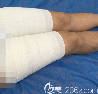 大腿吸脂第3天對(duì)比圖 大腿吸脂第3天對(duì)比圖