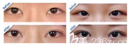 石家莊天宏做雙眼皮案例
