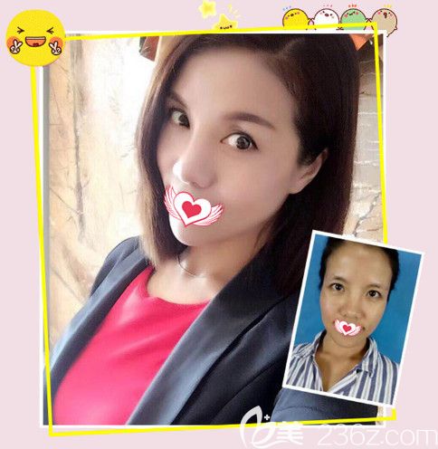 天宏整形醫(yī)院做鼻綜合案例