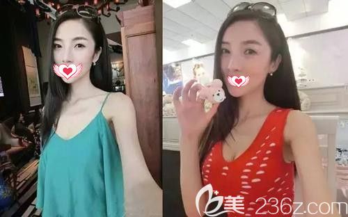 寺家莊天宏整形醫(yī)院隆胸案例