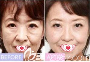 天宏整形醫(yī)院面部年輕化案例