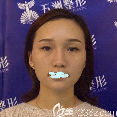 <!--<i data=20240703-sp></i>-->醫(yī)療整形美容醫(yī)院黃媛媛面部玻尿酸面部填充+瘦臉除皺瘦臉術(shù)前照 <!--<i data=20240703-sp></i>-->醫(yī)療整形美容醫(yī)院黃媛媛面部玻尿酸面部填充+瘦臉除皺瘦臉術(shù)前照