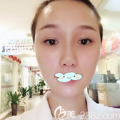 <!--<i data=20240703-sp></i>-->黃媛媛面部玻尿酸面部填充+瘦臉除皺瘦臉術(shù)后3天效果圖 <!--<i data=20240703-sp></i>-->黃媛媛面部玻尿酸面部填充+瘦臉除皺瘦臉術(shù)后3天效果圖