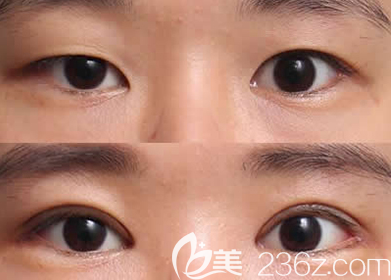 楊輝醫(yī)生切開(kāi)雙眼皮案例