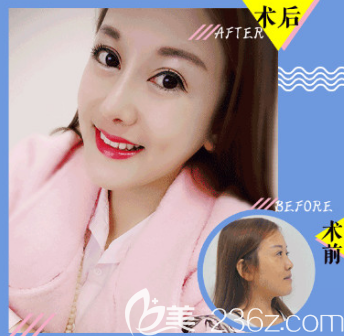 杜學(xué)瑩醫(yī)師隆鼻案例