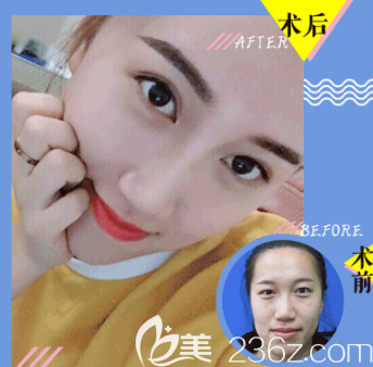 杜學(xué)瑩醫(yī)生全切雙眼皮案例