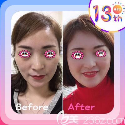 衡陽(yáng)雅美廖偉龍自體脂肪面部填充變化圖 衡陽(yáng)雅美廖偉龍自體脂肪面部填充變化圖