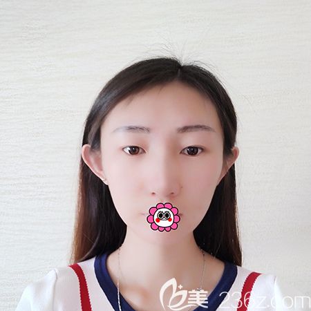 黑龍江瑞麗切開雙眼皮術(shù)前照 黑龍江瑞麗切開雙眼皮術(shù)前照