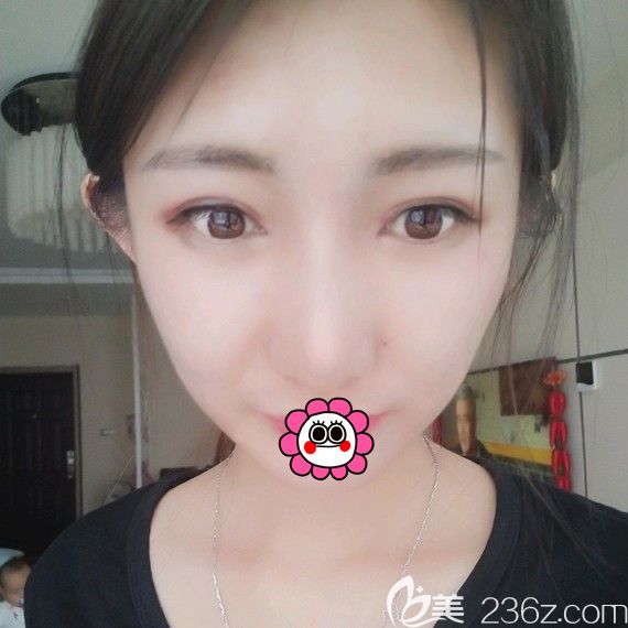 黑龍江瑞麗雙眼皮術(shù)后一個月效果 黑龍江瑞麗雙眼皮術(shù)后一個月效果