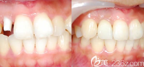 廣州圣貝口腔詹春華主任前牙種植效果圖 廣州圣貝口腔詹春華主任前牙種植效果圖