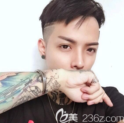 自體肋軟骨隆鼻術(shù)后一個(gè)月恢復(fù)效果