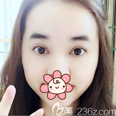 切開雙眼皮術(shù)后半個月恢復效果 切開雙眼皮術(shù)后半個月恢復效果