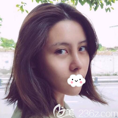 假體+耳軟骨復(fù)合隆鼻術(shù)后半個月 假體+耳軟骨復(fù)合隆鼻術(shù)后半個月