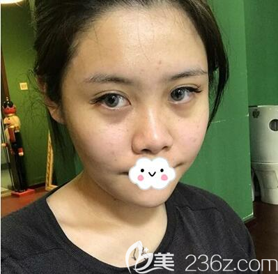 做耳軟骨隆鼻的術(shù)前照片 做耳軟骨隆鼻的術(shù)前照片