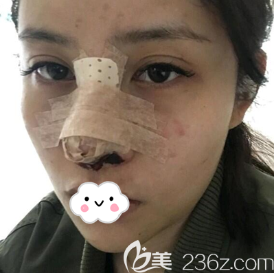 成都西區(qū)醫(yī)院鄧東偉隆鼻術(shù)后即刻 成都西區(qū)醫(yī)院鄧東偉隆鼻術(shù)后即刻