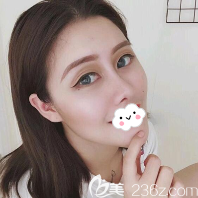 假體隆鼻+耳軟骨墊鼻尖綜合隆鼻3個月 假體隆鼻+耳軟骨墊鼻尖綜合隆鼻3個月