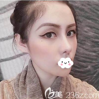 鄧東偉鼻綜合術(shù)后200天效果 鄧東偉鼻綜合術(shù)后200天效果